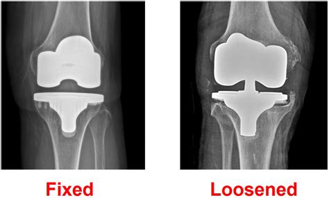 Machine Learning for Detecting Total Knee Arthroplasty Implant Loosening on Plain Radiographs