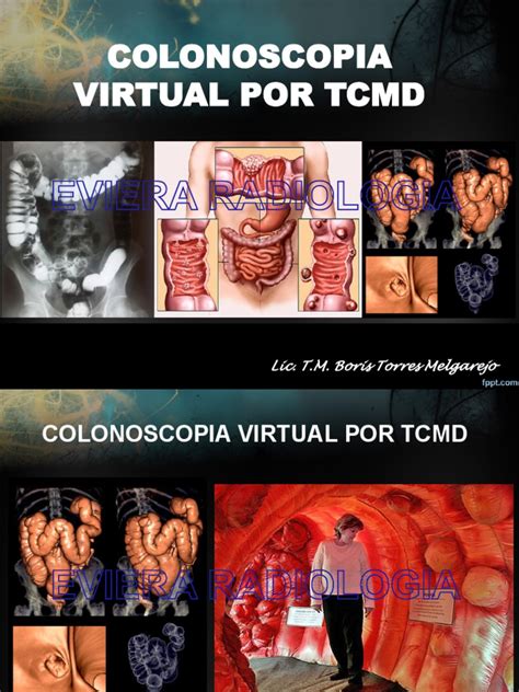 Image result for Endoscopia Virtual Colon