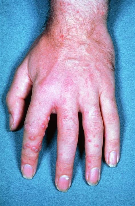 Shingles Rash On Hand Photograph by James Stevenson/science Photo Library