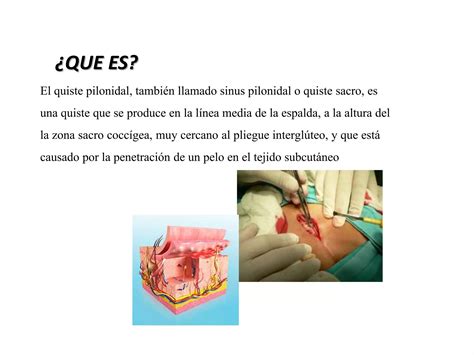 Quiste pilonidal | PPT