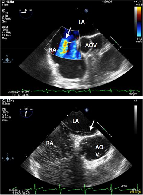 Comparison of atrial septal defect and patent foramen ovale in ...