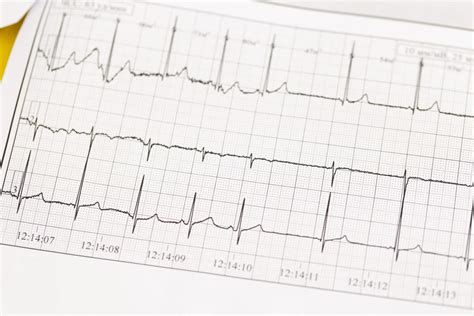QT prolongation - NYSORA