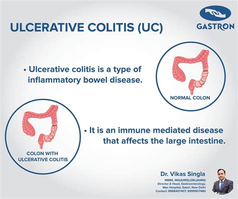 Ulcerative Colitis (UC) - Dr. Vikas Singla