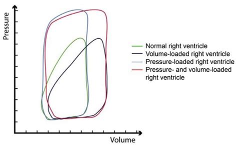 Right Ventricle-Predominant Cardiogenic Shock | Encyclopedia MDPI