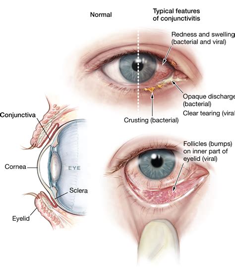 Pain Behind Eye Socket