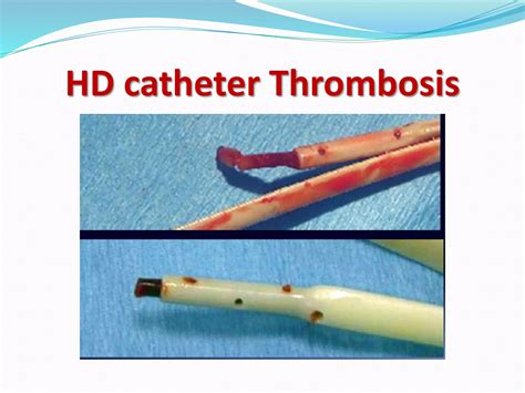 Tunnelled cuffed catheter (permacath) | PPTX