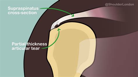 Supraspinatus Muscle Tear