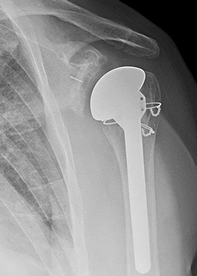 Anatomical Shoulder Replacement
