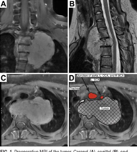 Image result for Clamshell Thoracotomy Cartoon