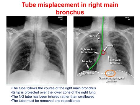CHEST XRAY TUBES.pptx,,,,,,,,,,,,,,,,,,, | PPTX