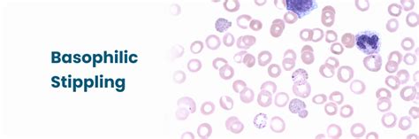 Basophilic Stippling: Causes, Diagnosis and Treatment