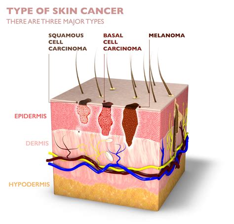 Skin Cancer | Reno Tahoe Dermatology | Best Reno Dermatologist