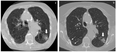 Thoracic Spine CT Hidden Treasures: Lung Assessment and Extraspinal ...