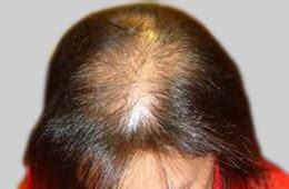 Female Pattern Baldness | Dr. Aditi's Homeopathy Hair Clinic