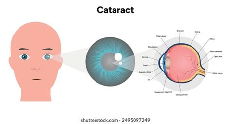 Vision Disorder 的图像结果