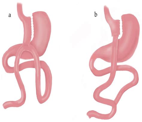 One Anastomosis Gastric Bypass versus Roux-en-Y Gastric Bypass: A Randomized Prospective Trial