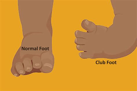 Clubfoot deformity | Triumph Therapeutics | Washington DC