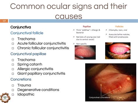 Protocol for differential diagnosis of common ocular diseases | PDF