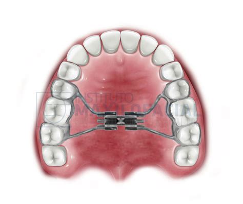 What is SARPE? - Instituto Maxilofacial