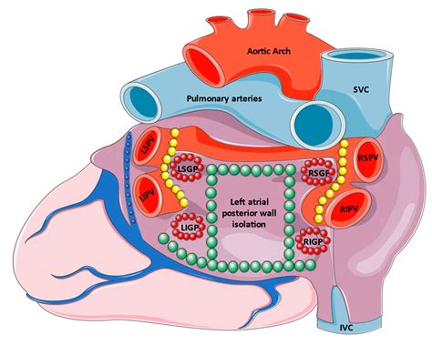 Percutaneous Treatment Approaches in Atrial Fibrillation: Current ...