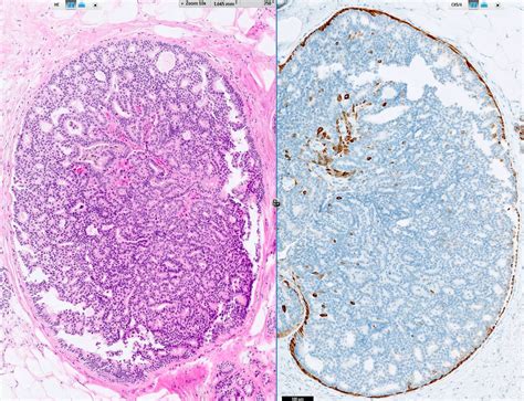 Pathology Outlines - Intraductal papilloma