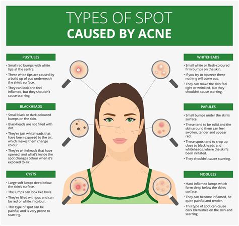 Understanding The Causes Of Acne - Ask The Nurse Expert