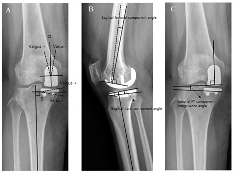Medicina | Free Full-Text | Spacer Block Technique Was Superior to Intramedullary Guide ...