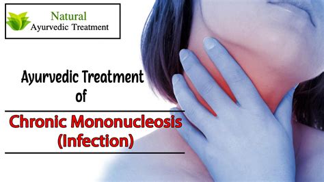 Mononucleosis Symptoms : 10 Signs and Symptoms of Mononucleosis ...