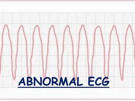 Image result for Normal vs Abnormal ECG