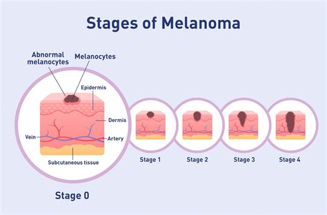 Melanoma Wide Excision at Ben Waterbury blog