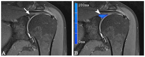 3-Tesla T2 Mapping Magnetic Resonance Imaging for Evaluation of SLAP Lesions in Patients with ...