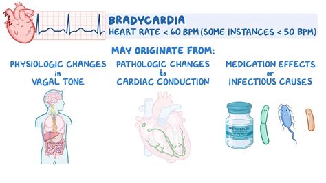 Approach to bradycardia: Video & Meaning | Osmosis