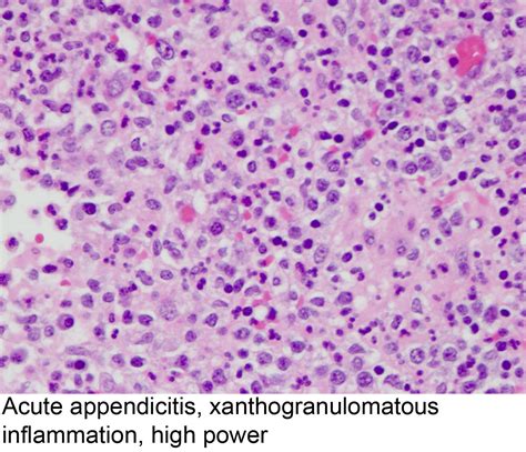 Is Appendicitis Hereditary