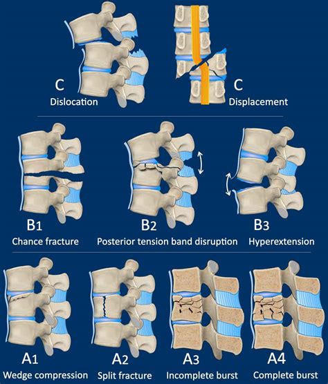 An Overview Of Thoracic Spine Fractures – LOOM