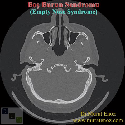 Health Zone Turkey: Empty Nose Syndrome (ENS)