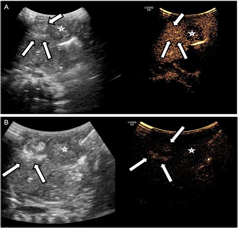 Unusual Progressive Hepatic Echogenicity of the Pediatric Liver Following Intravenous ...