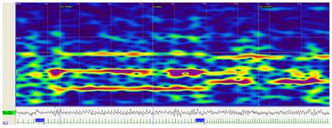 A Preliminary Study on Photic Driving in the Electroencephalogram of ...