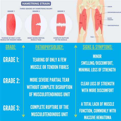Section 4 – Grades of Hamstring Injuries – Physio Performance