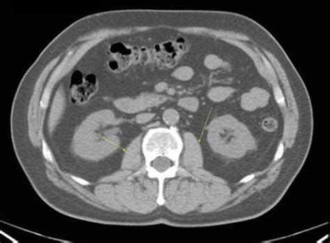 Ct Abdomen Normal