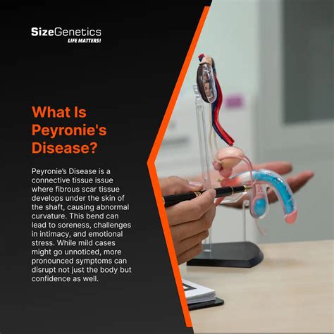 Addressing Peyronie's Disease: How SizeGenetics Can Help – Sizegenetics.com
