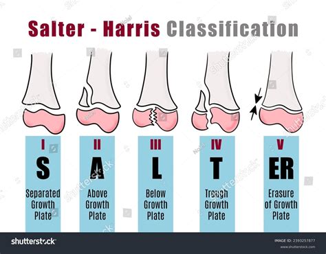 4 Salter Harris Type Fracture Royalty-Free Images, Stock Photos & Pictures | Shutterstock