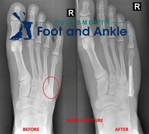 Hairline Fracture In Foot Boot at Ronald Wray blog