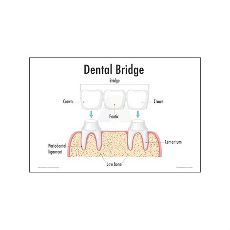 Anne Print Solutions® Dental bridge diagram Posters Size 13 X 19 Inch ...