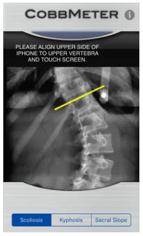 Scoliosis Management through Apps and Software Tools