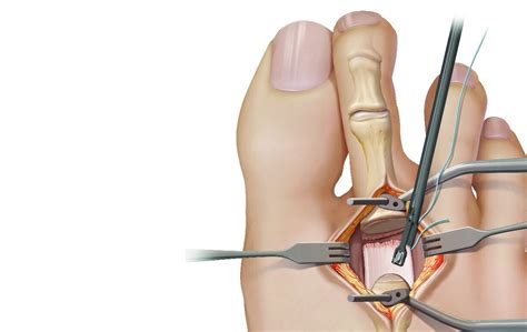Image result for Toe Surgery