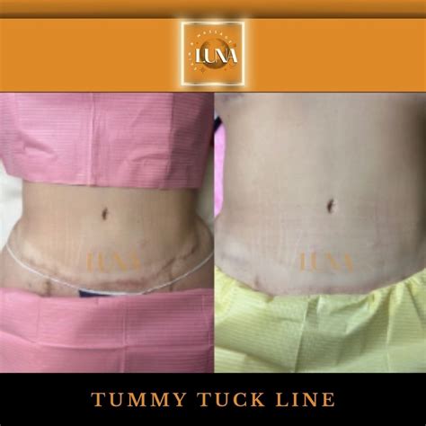 Tummy Tuck Scars