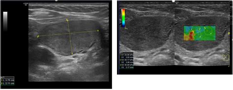 Shear Wave Elastography and Thyroid Imaging Reporting and Data System ...