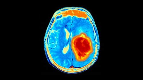 Fully paralysed man successfully communicates using computer interface ...