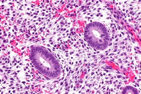 Image result for Disordered Proliferative Endometrium