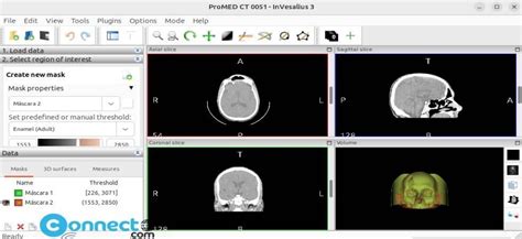 InVesalius Tutorial 的图像结果